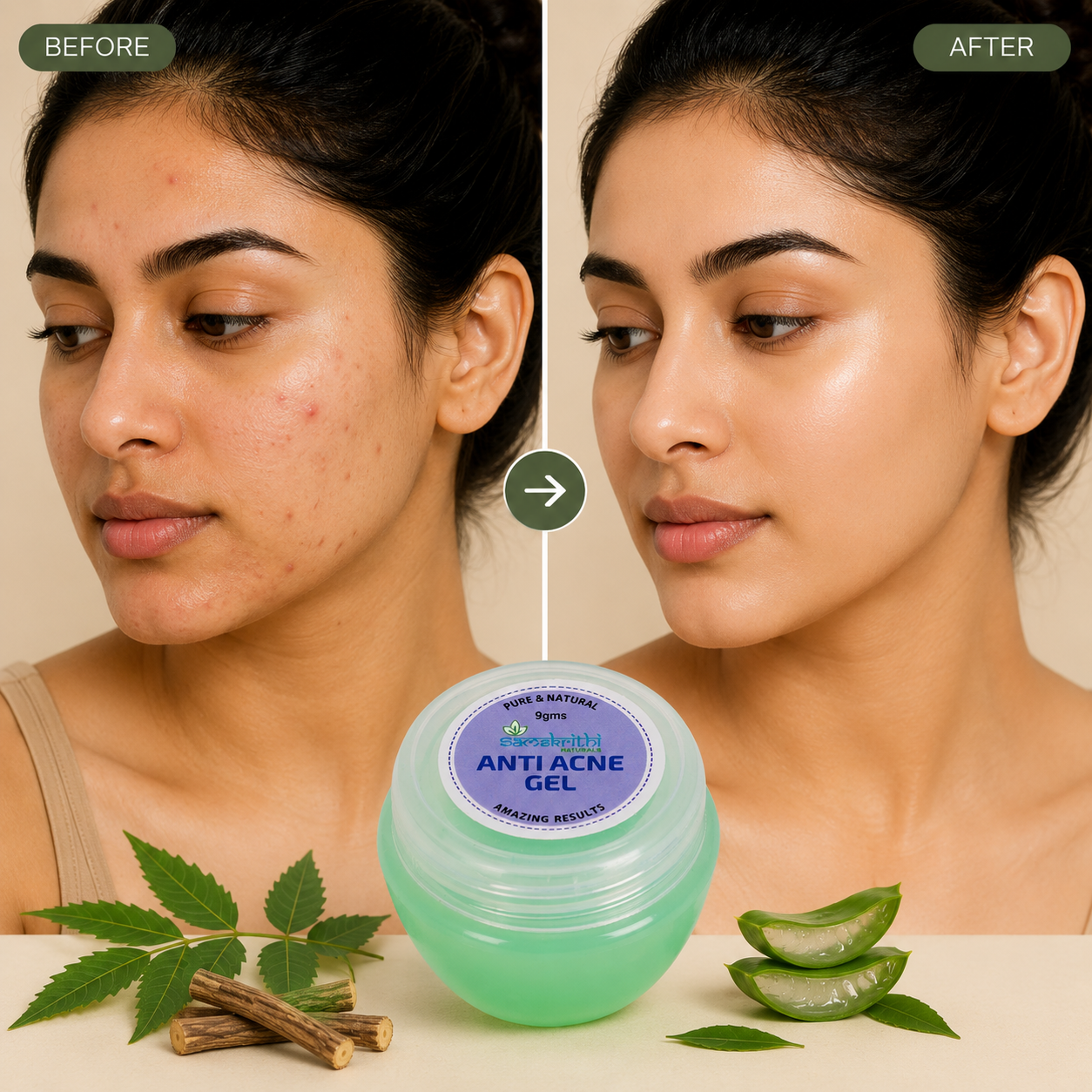 Anti Acne Gel